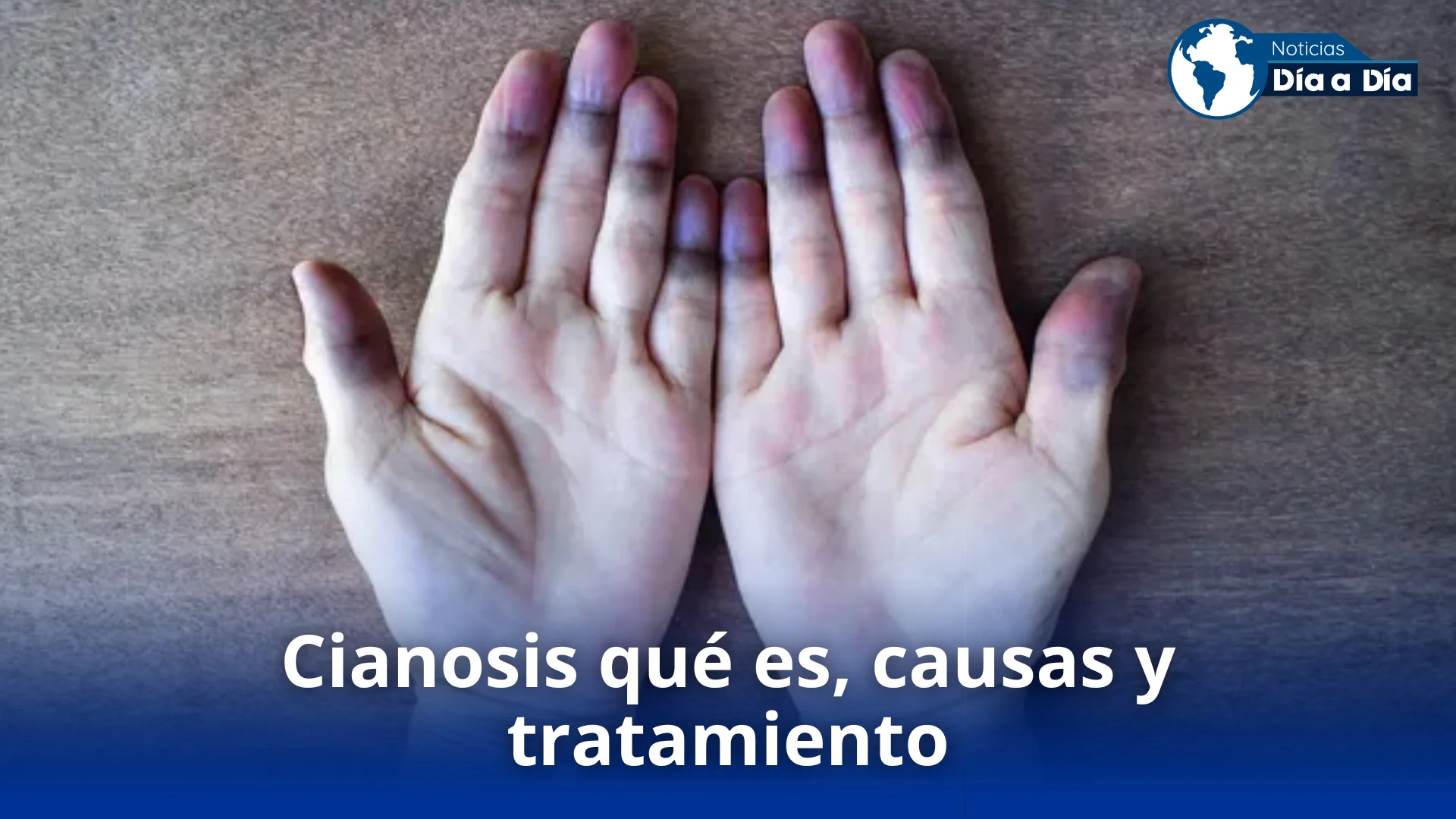 La Cianosis Un Síntoma que Revela Más de lo que Parece - Noticias de